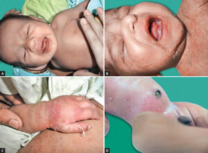 Skin Disease Congenital causes