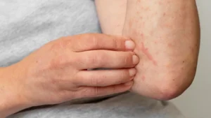 Skin Disease Physical causes